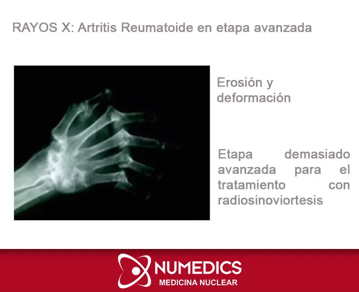 Estudio de Rayos x en etapa demasiado avanzada para el tratamiento con Radiosinoviortesis